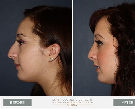 Rhinoplasty Denver | Nose Job | Nose Surgery | Rhinoplasty Near Me