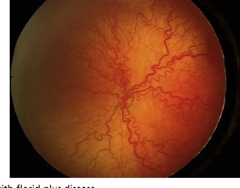 Figure 3 From The Challenge Of Screening For Retinopathy Of Prematurity Semantic Scholar