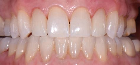 Composite Veneers Vs Porcelain Veneers Which One Is Better