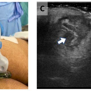 Infected pilonidal cyst. A) Natal cleft with small opening. B) Using... | Download Scientific ...