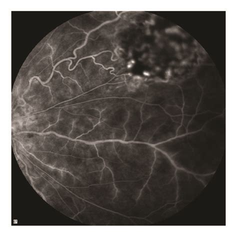 FFA Of The Right Eye Revealing Retinal Vasculitis And Astrocytoma