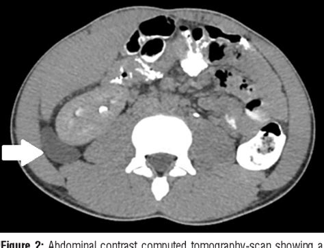 Symptomatic Müllerian Cyst In The Retroperitoneum Of An Adult Male Case Report And Review Of