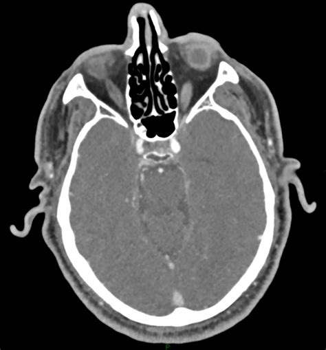 Angio Ct Shows Flow In The Right Internal Carotid Artery At The Level Download Scientific