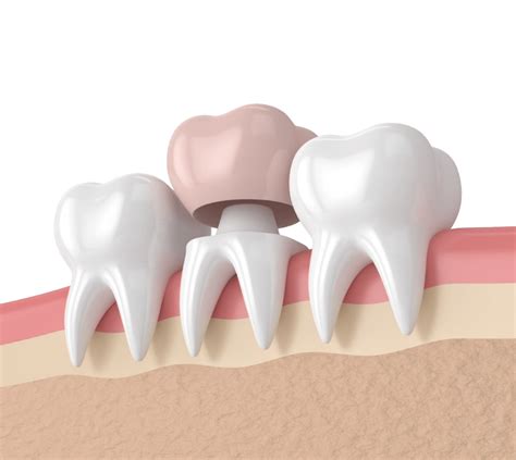 Dental Crowns And Bridges Services In Dwarka Apex Dental Clinic