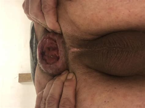 Anal Dilation After Big Insertion Nude Pics Xhamster