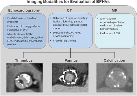 Bioprosthetic Heart Valve Degeneration And Dysfunction Focus On