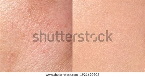 1,072 Before After Skin Whitening Images, Stock Photos & Vectors | Shutterstock