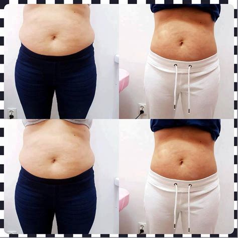 Velashape Before And After Vivalaser For You For All For Beauty