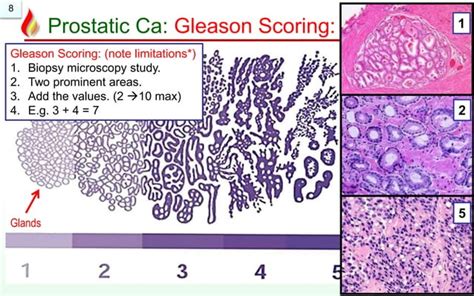 Pathology Of Prostate Cancer