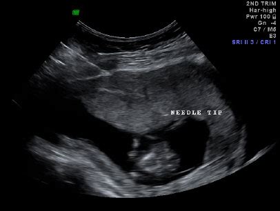 Chorionic Villi Ultrasound