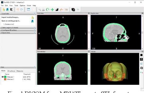 Figure 1 From 3d Printing Of Human Anatomical Models For Preoperative