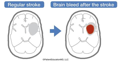 Brain Bleed After A Stroke Patienteducationmd