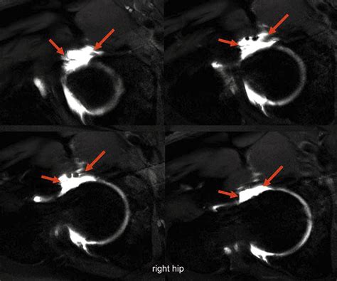 Anatomic Hip Capsular Reconstruction With Separate Suture Anchors