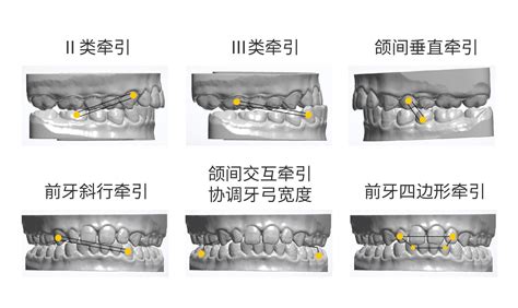 正畸课程合辑隐形矫治中的牵引类型和矫治器的开口方向 知乎