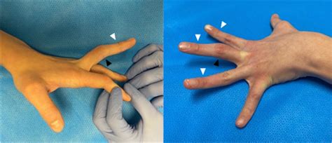 Boutonniere Versus Pseudoboutonniere Deformities Pathoanatomy Diagnosis And Treatment