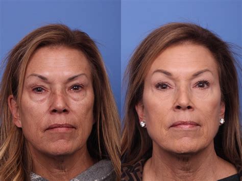 Blepharoplasty Before And After Pictures Case 459 Scottsdale