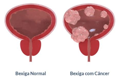 C Ncer De Bexiga Dr Filipe Sena