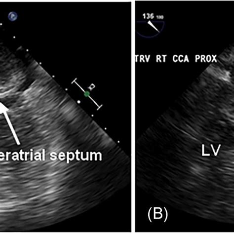 Transesophageal Echocardiogram A Bicaval View Demonstrating The Left Download Scientific