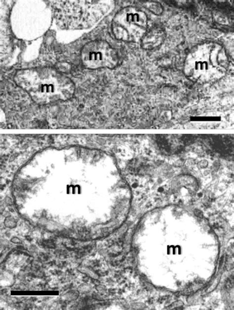 Typical Ultrastructure Of Mitochondria From A Human Glioblastoma That Download Scientific