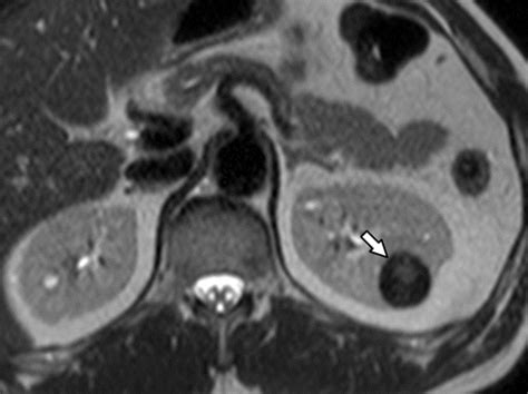 T Hypointense Renal Lesion