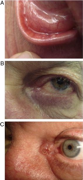 Rosacea And Rhinophyma In The Elderly Clinics In Dermatology