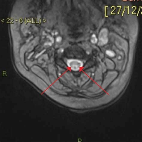 Mri Spine Demonstrating Symmetrical High Signalling In The Dorsal Download Scientific Diagram