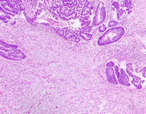 Adenocarcinoma Colon Histology