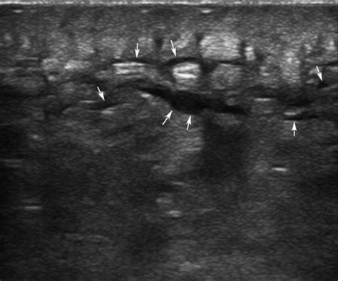 Sonography First For Subcutaneous Abscess And Cellulitis Evaluation