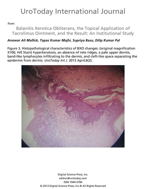 Balanitis Xerotica Obliterans