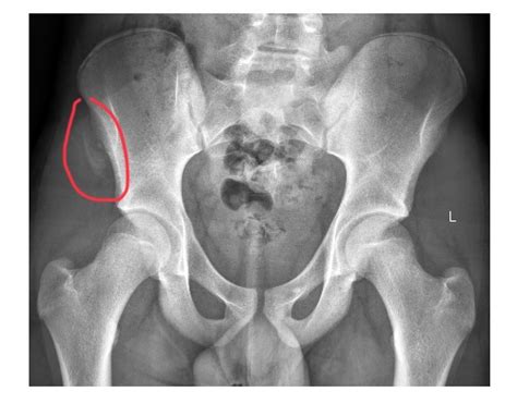 Anterior Superior Iliac Spine X Ray