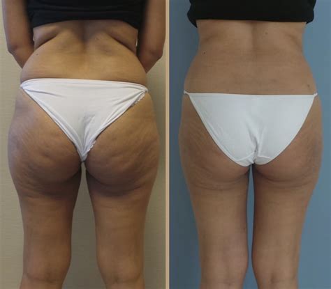 Liposuction In Turkey Op Dr Atilla Fesli