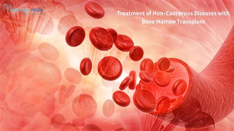 Bone Marrow Transplantation For Non Cancerous Diseases Bmt In India