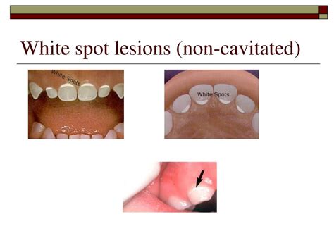 Ppt Introduction Of Priority Oral Health Risk Assessment And Referral