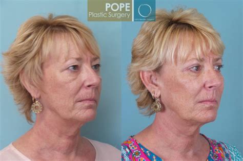 Eyelid Surgery Before And After Pictures Case 23 Orlando Fl Pope Plastic Surgery