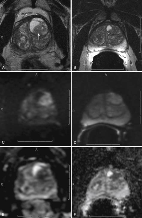 Mri Of The Prostate And Male Genitourinary System Clinical Tree