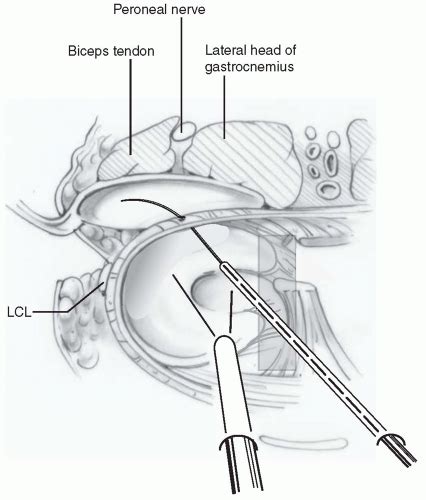 Medial And Lateral Meniscus Transplantation Arthroscopic Assisted