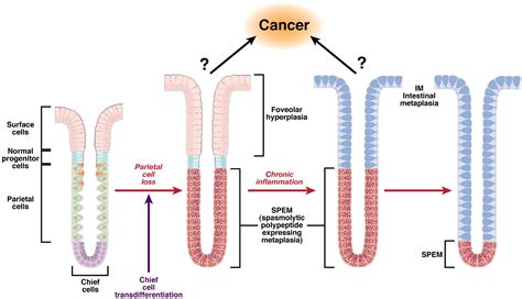 Spasmolytic Polypeptide Expressing Metaplasia And Intestinal Metaplasia Time For Reevaluation