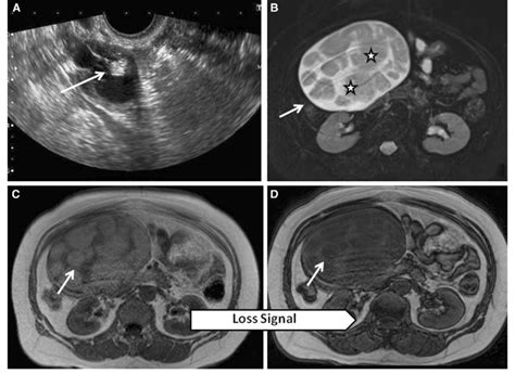 Cystic Teratoma A Transverse Sonogram Shows Complex Cystic And Solid Download Scientific