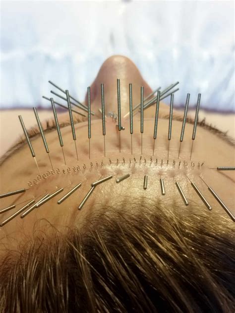 akupunktura kosmetyczna spa osowa