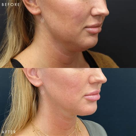 Las Vegas Chin CoolSculpting Treatment Sculpt Spa