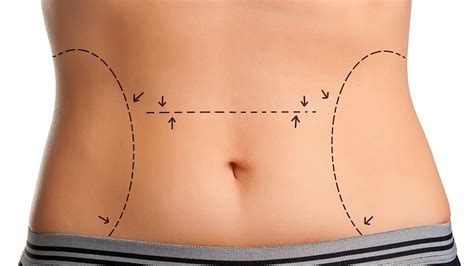 Does A Tummy Tuck Leave A Big Scar Plastic Surgery Youtube