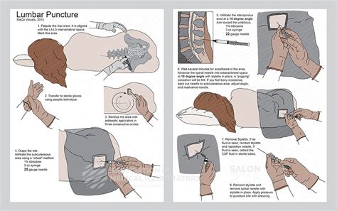 Lumbar Puncture Procedure | AMI Cleveland 2015