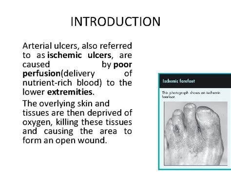 Arterial Ulcers Introduction Arterial Ulcers Also Referred To