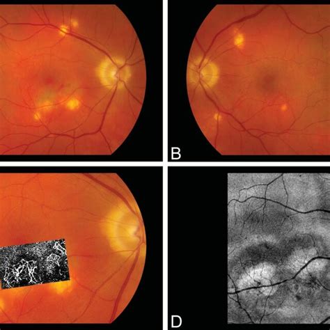 Color Fundus Photograph Of The Right A And Left B Eyes Showing