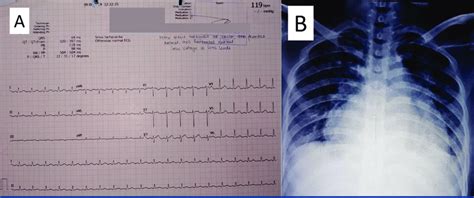 A Electrocardiography Showed Sinus Tachycardia Bpm And Normoaxis