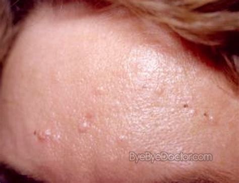 Sebaceous Hyperplasia - Treatment, Removal, Pictures, Causes, Prevention