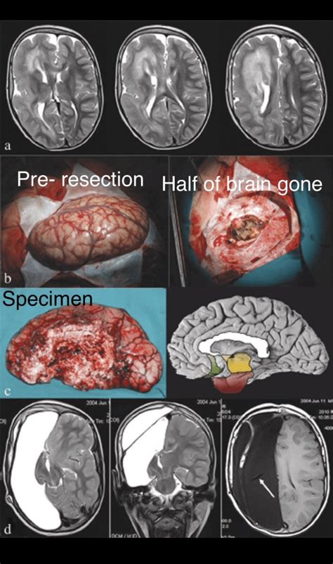 Oren Gottfried, MD on Twitter: "Can you remove brain and maintain functions? Yes, & these ...