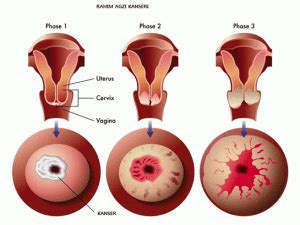 Rahim A Z Kanseri Serviks Kanseri Nedir Belirtileri Ve Tedavisi
