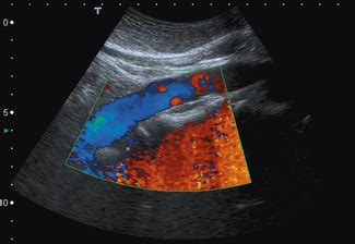 Physical principles of Doppler ultrasound | Radiology Key