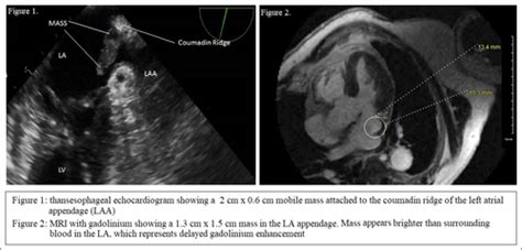 Coumadin Ridge Mass Difficulties In Differential Diagnosis And